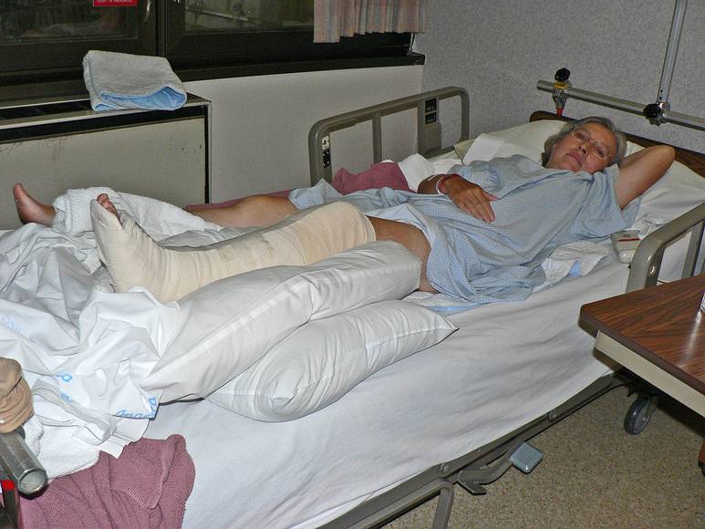 August 21, 2007 - Palm Drive Hospital, Sebastopol, California.<br />Joyce with her operated leg (steel rod and screws).