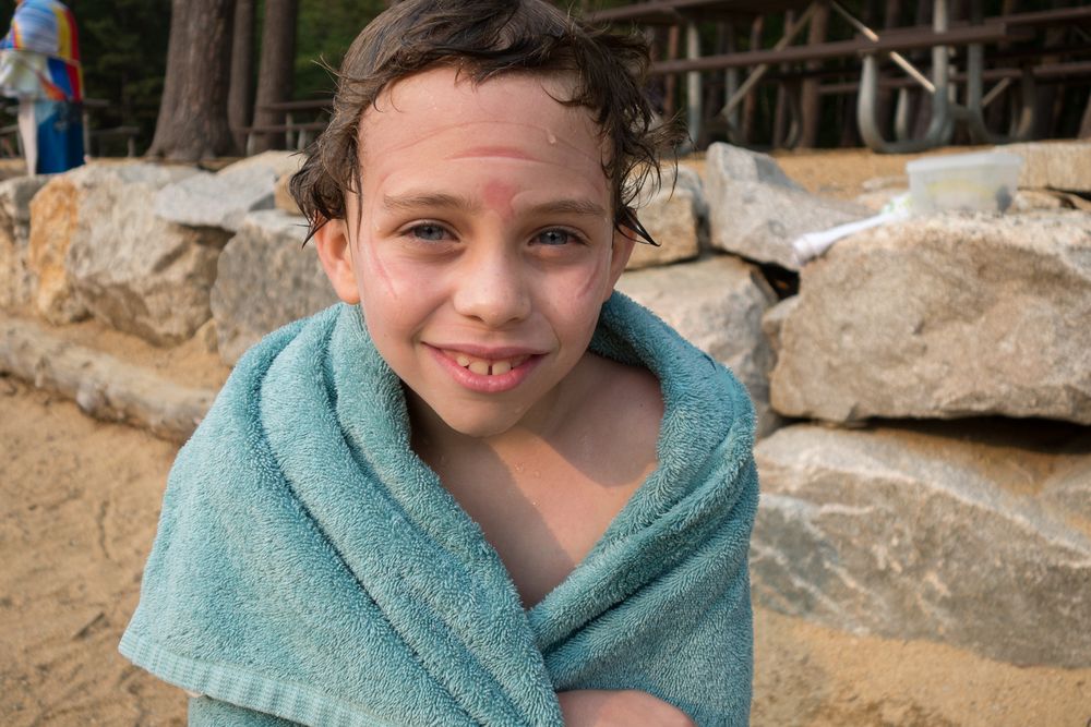 Matthew with face mask marks.<br />July 25, 2014 - Echo Lake, Conway, New Hampshire.